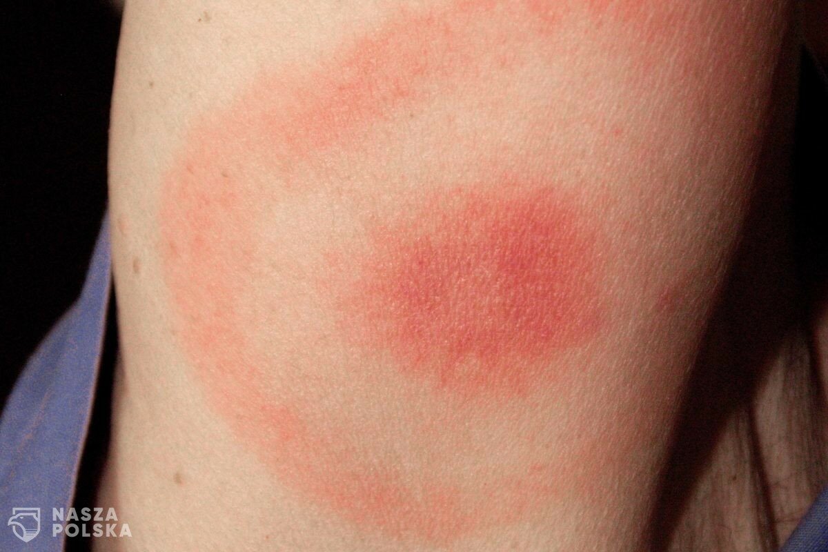 Od stycznia do połowy lipca odnotowano w Polsce 4373 przypadki boreliozy