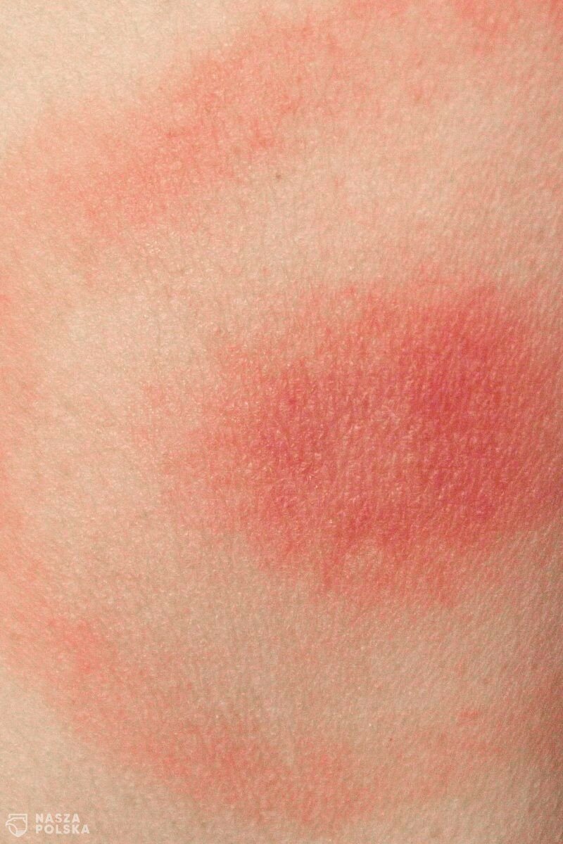 Od stycznia do połowy lipca odnotowano w Polsce 4373 przypadki boreliozy